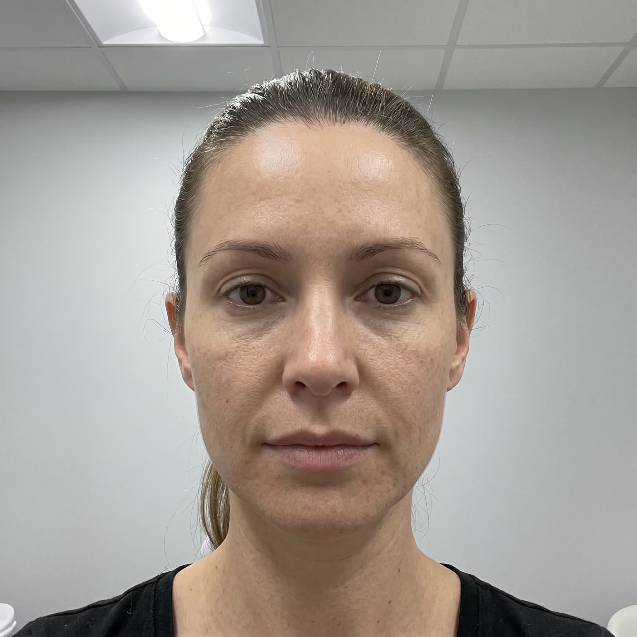 Facial contouring result, shown with patient consent