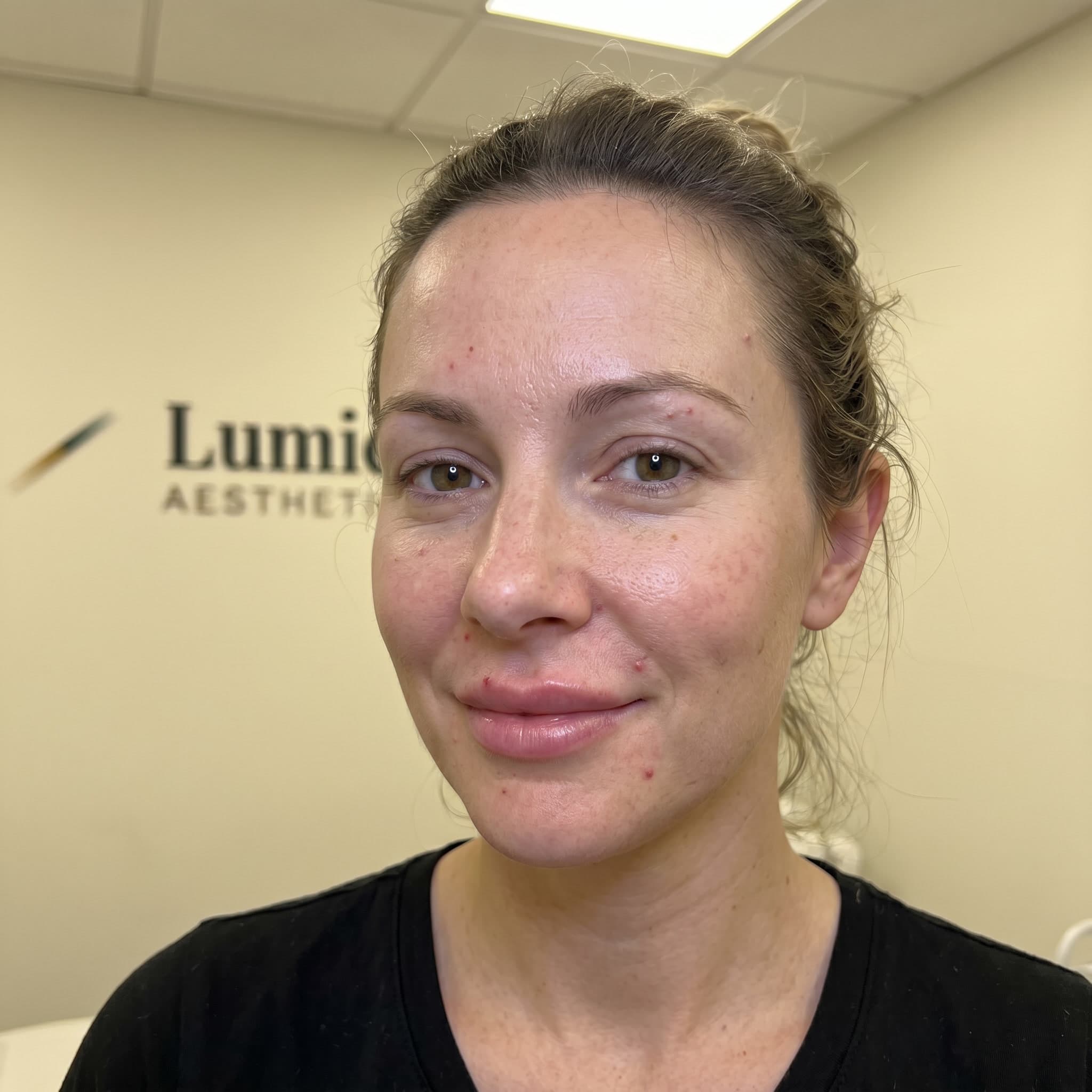 Laser resurfacing result, shown with patient consent