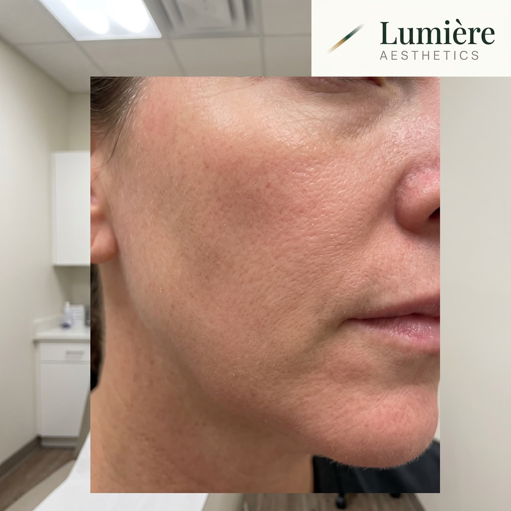 Skin texture result, shown with patient consent